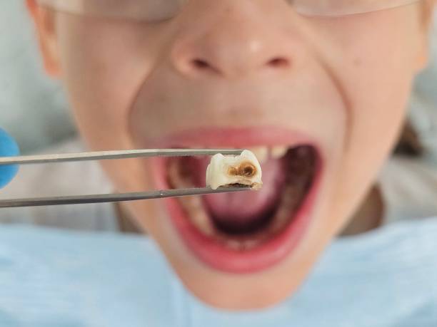 Best Cracked Tooth Emergency Dentist  in Angola, NY